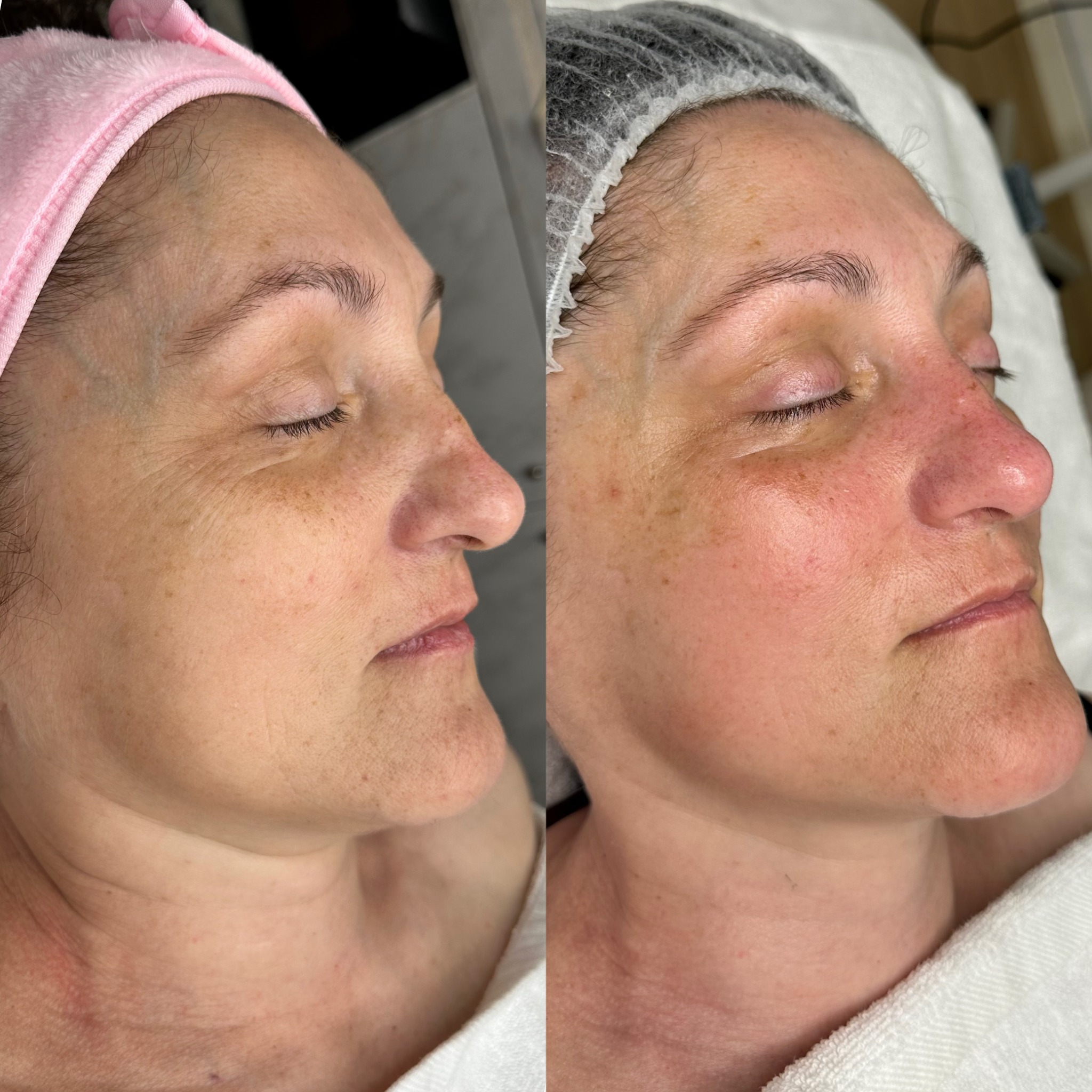 Antes y después de tratamiento facial personalizado en LauSarAnt Estética