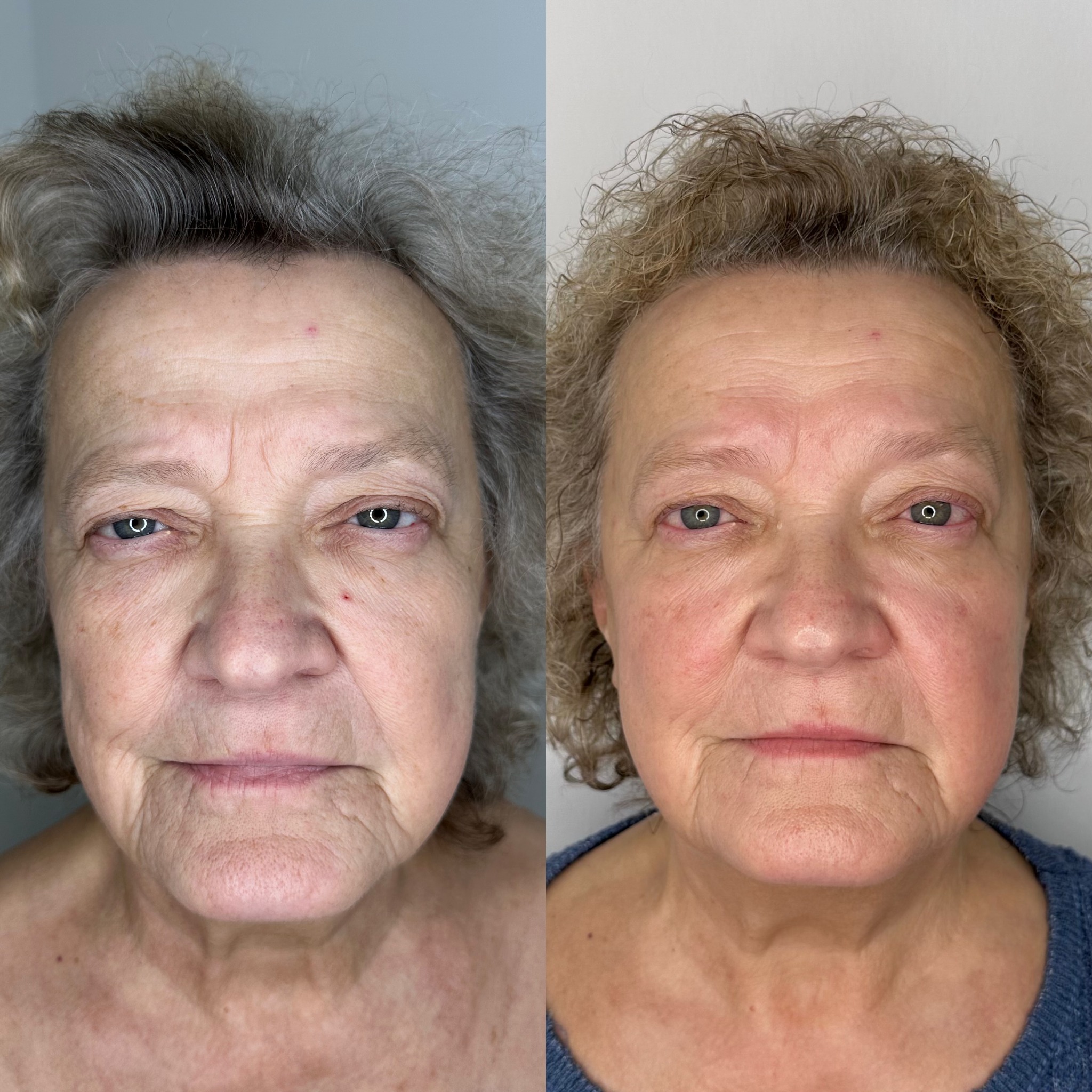 Antes y después de cuidado facial personalizado en Barcelona