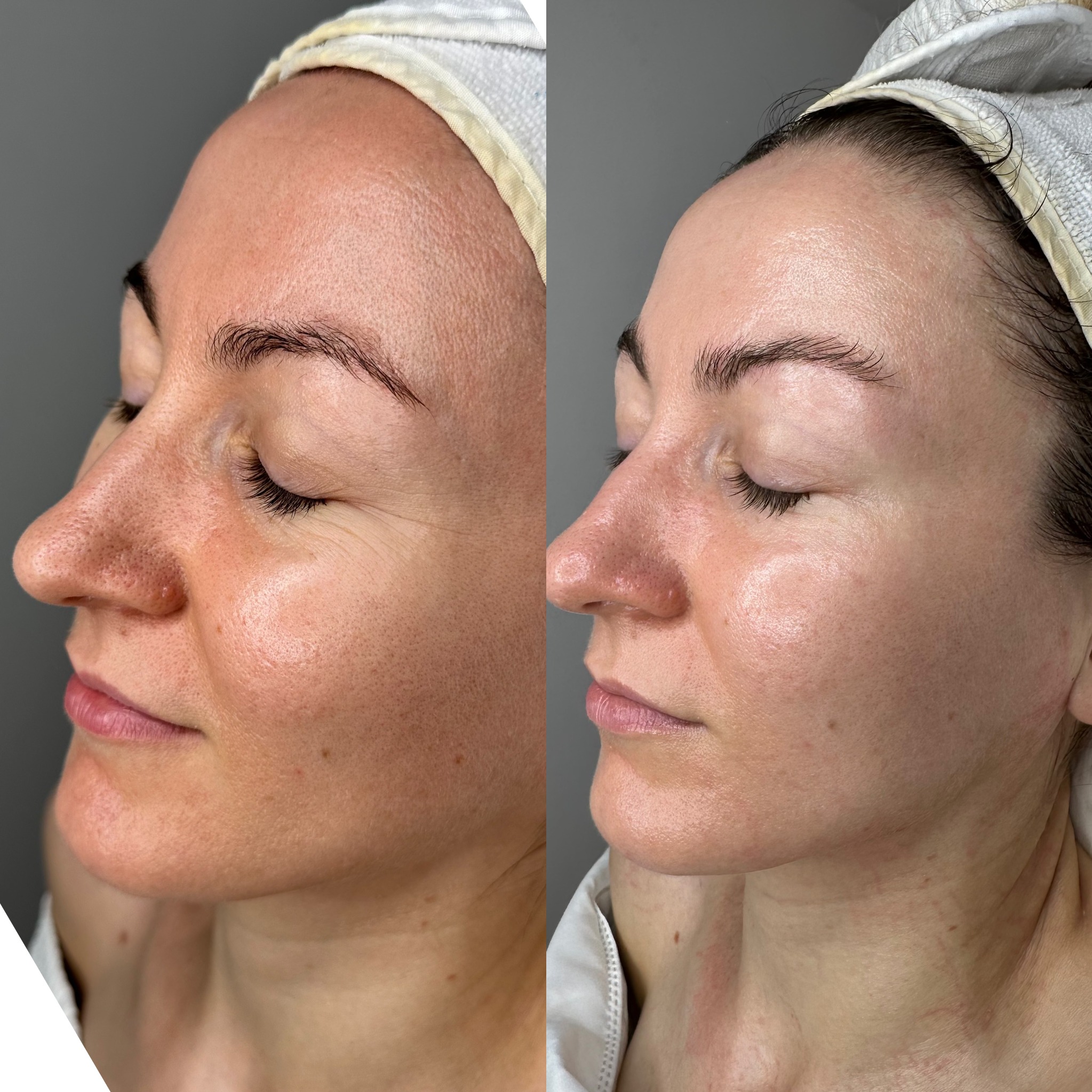 Resultado real antes y después de tratamiento facial