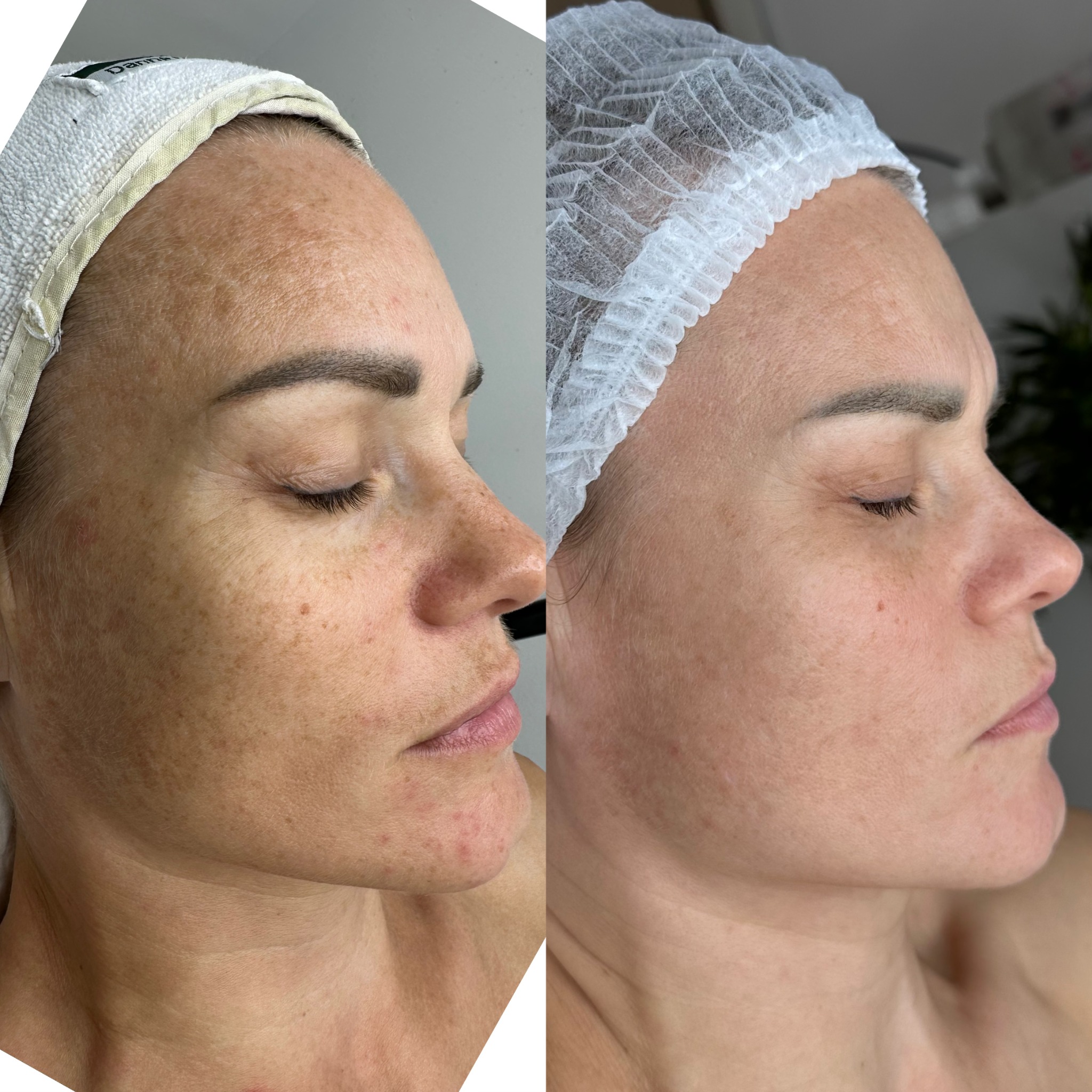 Resultado de tratamiento facial personalizado en LauSarAnt Estética
